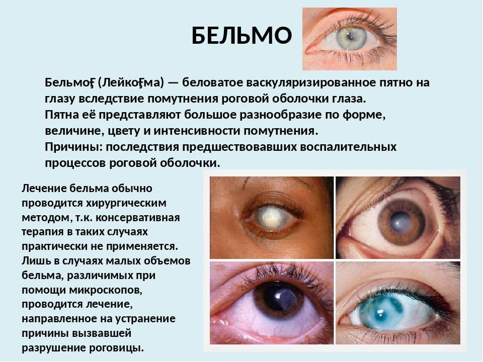 Болезни глаз у кошек: конъюнктивит, катаракта, кератит, глаукома у котов