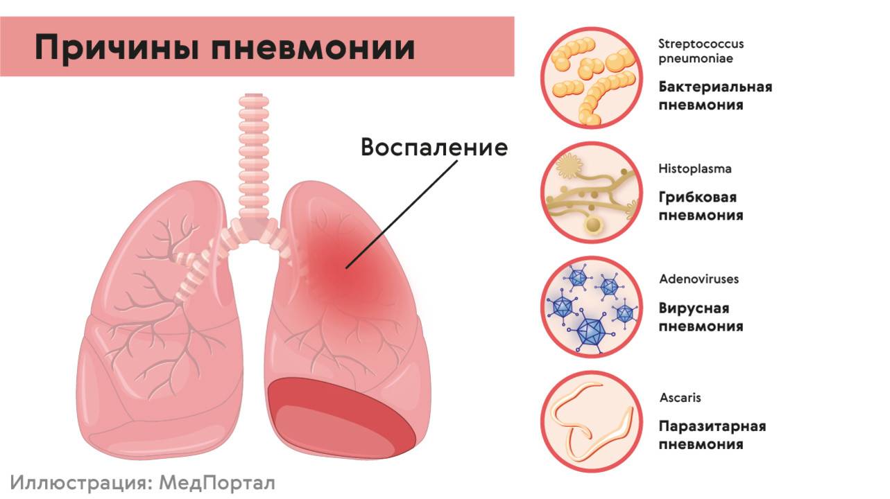 Пневмония – симптомы и признаки у взрослых и детей
