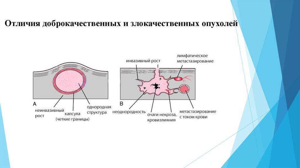 Рак кишечника - прямой, толстой, слепой кишки: лечение, симптомы рака - клиника лисод в киеве, украине