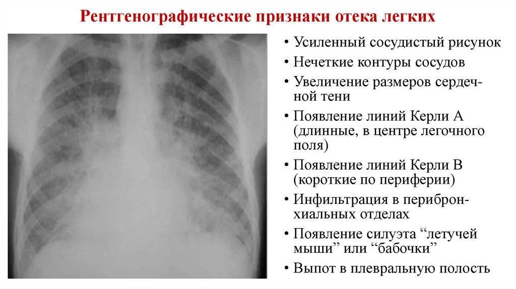 Рентгенологическая картина отека легких