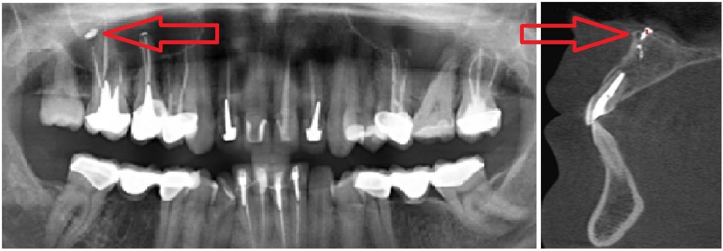 Ноет зуб после лечения. Тройничный нерв на рентгене зуба. Снимок зуба после резекции. Пломбировочный материал в нижнечелюстном канале.
