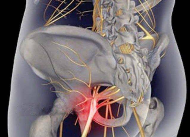 Защемление седалищного нерва ️: симптомы, признаки и причины, диагностика и лечение