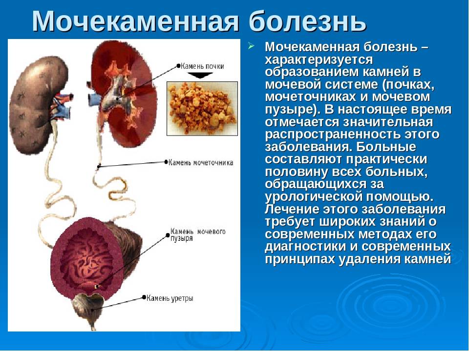 Клиническая картина мочекаменной болезни