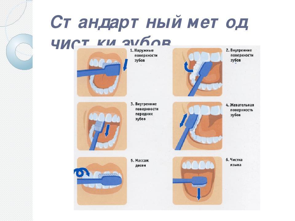 Как делают профессиональную чистку зубов?