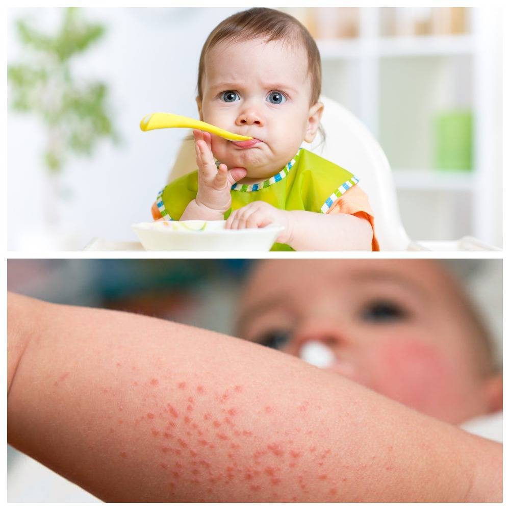 Аллергия на яичный белок у ребенка фото