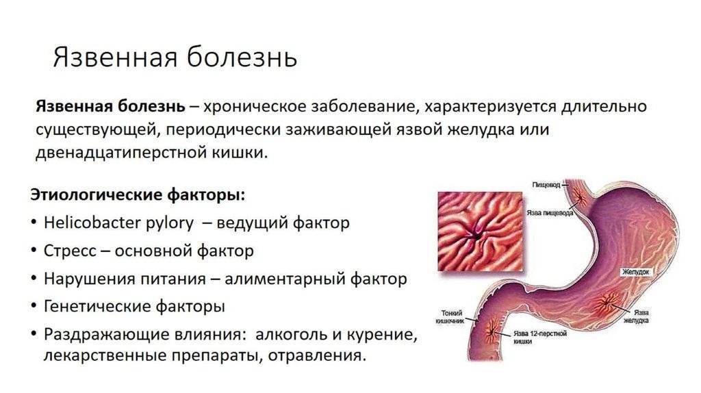 Sintomas de helicobacter