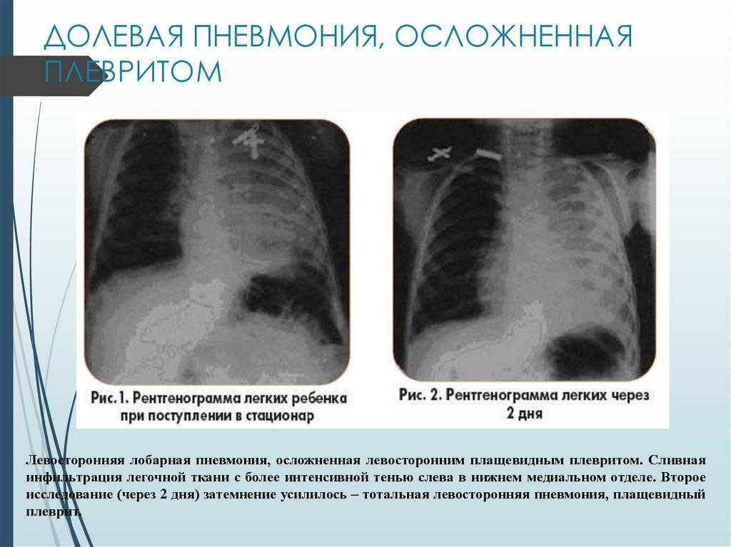Коварный инфекционный мононуклеоз: разберемся, чем он опасен и как его обнаружить - статьи lab4u.ru
