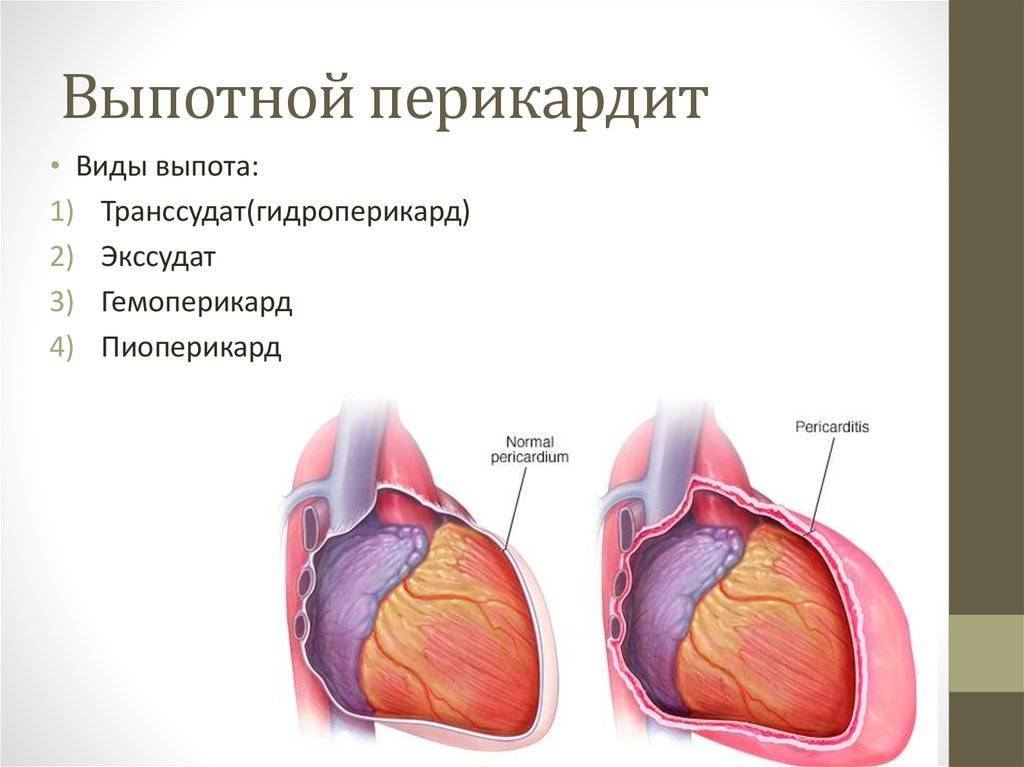 Констриктивный перикардит: клинический случай | интернет-издание "новости медицины и фармации"