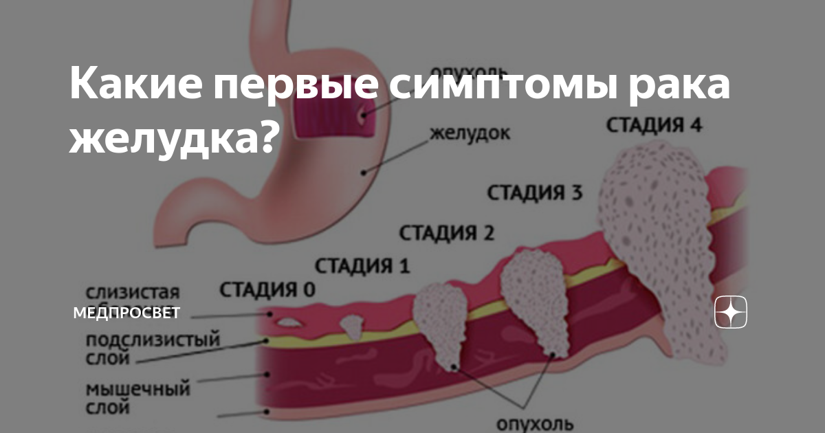 Может ли при онкологии. Злокачественное новообразование желудка. Опухоль желудка симптомы. Онкология желудка симптомы.