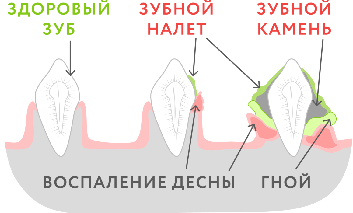 Зубные камни, удаление зубных камней ультразвуком