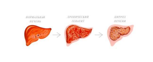 Заболевания желчных и печеночных протоков