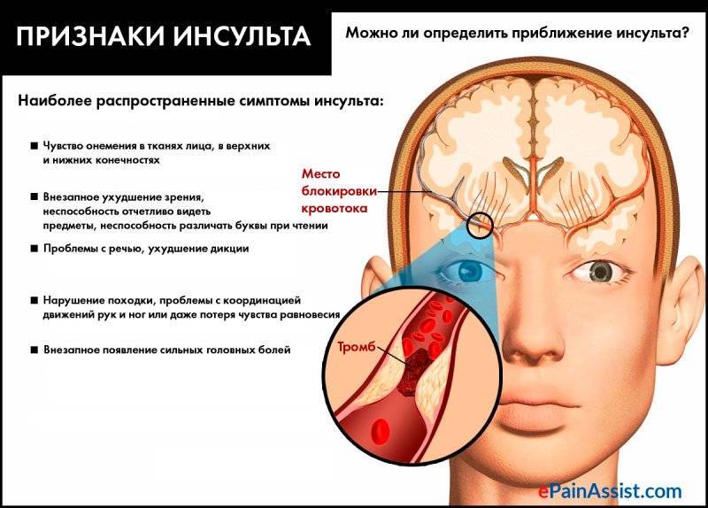 Микроинсульт это