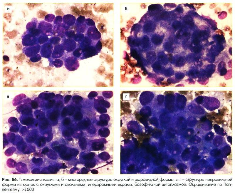 Аденокарцинома цитологическая картина